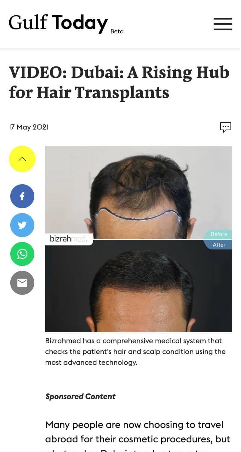 hair-transplant-bizrahmed-gulf-today